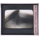 La Radiographie appliquée aux Sciences médicales. Fracture du coude, enfant.