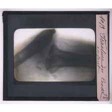 La Radiographie appliquée aux Sciences médicales. Fracture du coude, enfant.