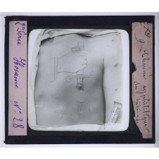 Conférence antivénérienne faite à des officiers et soldats. 2ème Série. Chancre syphilitique du tatouage.