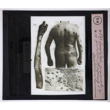 Maladies de la peau causées par des parasites. 2e série: insectes et champignons. 1° Sporotrichose gommeuse généralisée; 2° sporotrichose ulcéreuse avec lymphangite; 3° sporotrichum Beurmanni.