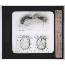 Maladies de la peau causées par des parasites. 2e série: insectes et champignons. 1° Sillon de la gale - 2° Sarcoptes scabiei.