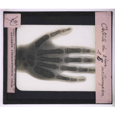La Radiographie appliquée aux Sciences médicales. Ostéïte du 5ème métacarpien.