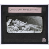Vues anti-alcooliques. 1ère période; période épileptoïde.