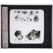 Maladies de la peau causées par des parasites. 2e série: insectes et champignons. 1° Filament d'Actinomyces bovis - 2° Actinomycose du maxillaire inférieur chez la femme, chez le bœuf.