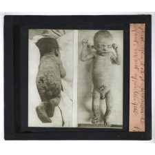 La Protection et la préservation de l'enfant avant sa naissance. Enfant syphilitique.