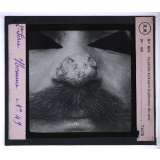 Conférence antivénérienne faite à des officiers et soldats. 2ème Série. Syphilis tertiaire lupiforme du nez.