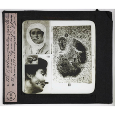 Prophylaxie des maladies contagieuses. 2e série. Transmises par les produits cutanés, le pus, les sécrétions oculaires, les parasites. 1° Actinomycose du maxillaire inférieur chez un Kabyle; 2° grain jaune; 3° actinomycose de la joue.