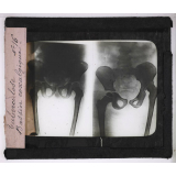 La Tuberculose. Bassin coxalgique.