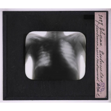 La Radiographie appliquée aux Sciences médicales. Thorax. Turbercules pulmonaires du sommet droit.