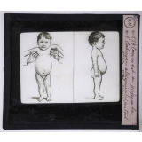 Les Dessanglés du ventre. Comment on prépare la déchéance abdominale : un tout jeune mal nourri.