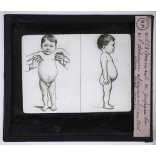 Les Dessanglés du ventre. Comment on prépare la déchéance abdominale : un tout jeune mal nourri.