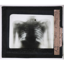 La Tuberculose. Tuberculose 3e degré.