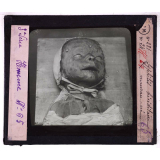 Conférence antivénérienne faite à des officiers et soldats. 3ème Série. Syphilis héréditaire, nouveau né.