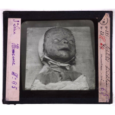 Conférence antivénérienne faite à des officiers et soldats. 3ème Série. Syphilis héréditaire, nouveau né.