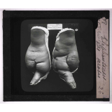Les Animaux parasites de l'homme. Elephantiasis des arabes.