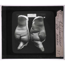 Les Animaux parasites de l'homme. Elephantiasis des arabes.