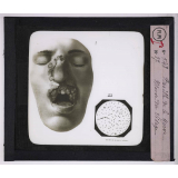 Maladies de la peau causées par des microbes. Bacille de la morve - Morve du visage.