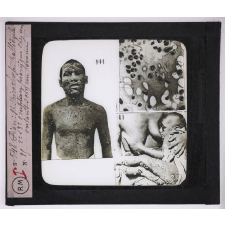 Maladies de la peau causées par des microbes. Pian : Éruption pianique chez un enfant et chez un homme. 