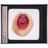 Maladies de la peau causées par des microbes. Plaques muqueuses de la bouche.