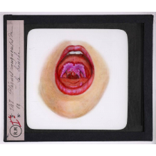 Maladies de la peau causées par des microbes. Plaques muqueuses de la bouche.