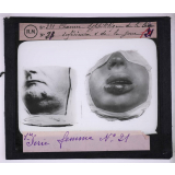 Conférence antivénérienne faite à des ouvrières. 1ère Série. Chancre syphilitique de la lèvre inférieure et de la joue.