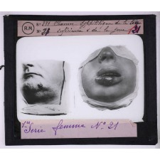 Conférence antivénérienne faite à des ouvrières. 1ère Série. Chancre syphilitique de la lèvre inférieure et de la joue.
