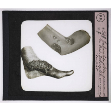 Maladies de la peau causées par des parasites. 2e série: insectes et champignons. Tuberculose ulcéro-gommeuse du bras - Tuberculose verruqueuse du pied.