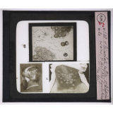 Maladies de la peau causées par des microbes. 1° Spirochæte pallida; 2° Alopécie en aires; 3° Syphilides pigmentaires du cou.