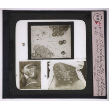 Maladies de la peau causées par des microbes. 1° Spirochæte pallida; 2° Alopécie en aires; 3° Syphilides pigmentaires du cou.