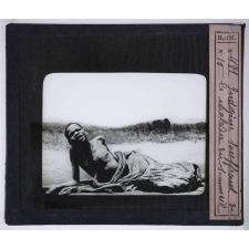 Les Trypanosomiases et la maladie du sommeil. Indigène souffrant de la maladie du sommeil.