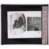 Maladies de la peau causées par des parasites. 2e série: insectes et champignons. 1° Carathès;  2° Squame épidermique d'un carathès montrant les pinceaux d'aspergillus.