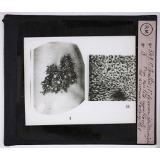 Maladies de la peau causées par des parasites. 2e série: insectes et champignons. 1° Carathès;  2° Squame épidermique d'un carathès montrant les pinceaux d'aspergillus.