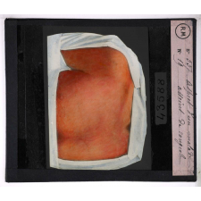 Prophylaxie des maladies contagieuses. 1ère série. Transmises par les déjections, les matières fécales, l'eau souillée; les sécrétions respiratoire. Aspect d'un malade atteint de rougeole.