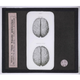 Vues anti-alcooliques. Cerveau normal et cerveau alcoolique.