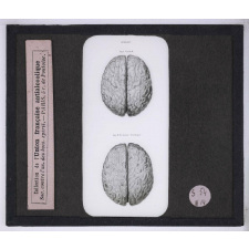 Vues anti-alcooliques. Cerveau normal et cerveau alcoolique.