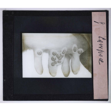 Les Etapes de la préservation de la variole. Cowpox.