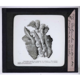 La Tuberculose bovine et les moyens de la combattre. Tuberculose massive des ganglions du médiastin.
