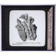 La Tuberculose bovine et les moyens de la combattre. Tuberculose massive des ganglions du médiastin.