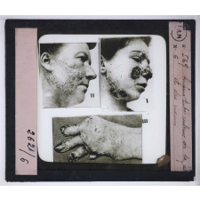 La Tuberculose, maladie sociale. Lupus tuberculeux de la face et des mains.