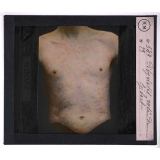 Maladies de la peau causées par des parasites. 2e série: insectes et champignons. Pityriasis rosé de Gibert.