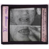 Conférence antivénérienne faite à des officiers et soldats. 3ème Série. Malformation hérédosyphilitique des dents.
