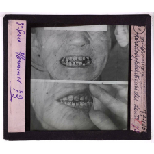 Conférence antivénérienne faite à des officiers et soldats. 3ème Série. Malformation hérédosyphilitique des dents.