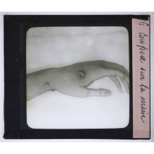 Les Etapes de la préservation de la variole. Cowpox sur la main.