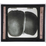 Vues anti-alcooliques. Dégénerescence graisseuse du foie. Atlas du docteur Lancereaux.