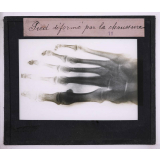 La Radiographie appliquée aux Sciences médicales. Pied déformé par la chaussure.