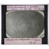 Les Maladies du cuir chevelu. Tondante à petites spores de Gruley St Louis, Musée de l'hôpital St Louis.