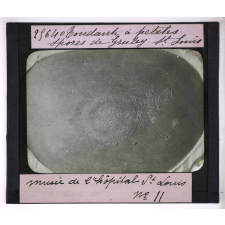 Les Maladies du cuir chevelu. Tondante à petites spores de Gruley St Louis, Musée de l'hôpital St Louis.