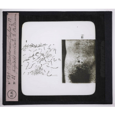 Maladies de la peau causées par des parasites. 2e série: insectes et champignons. 1° Microsporum furfur; 2° Pityriasis versicolor de l'abdomen.