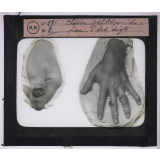 Les Maladies vénériennes. Chancre syphilitique du pouce et des doigts.