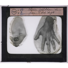 Les Maladies vénériennes. Chancre syphilitique du pouce et des doigts.
